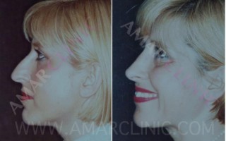 Nose surgery at London FAMI Clinic