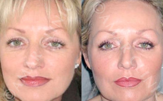 FAMI non-surgical facelift one