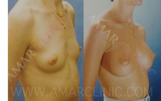 Breast Implants subpectoral