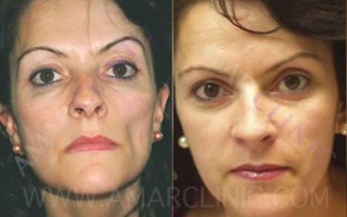 Treating facial defects with London FAMI Clinic technique