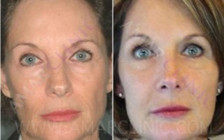 FAMI the truly natural facelift