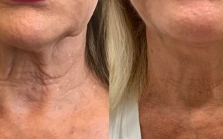 Before and after pinch neck lift